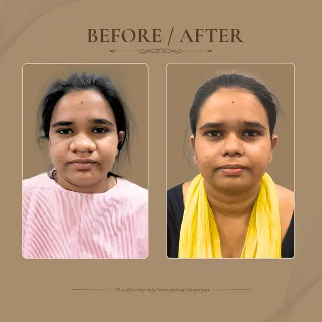Rhinoplasty before and after result 1