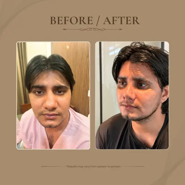 Rhinoplasty before and after result 2
