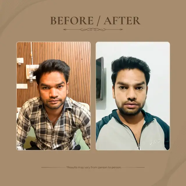 Rhinoplasty before and after result 3