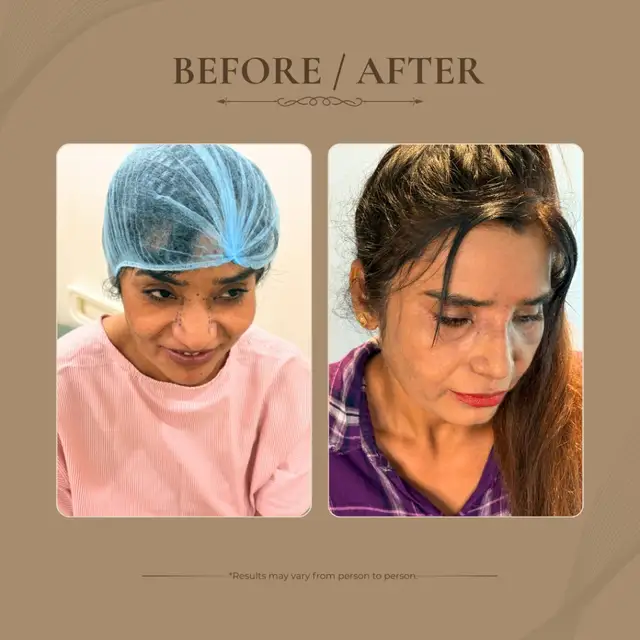 Rhinoplasty before and after result 4
