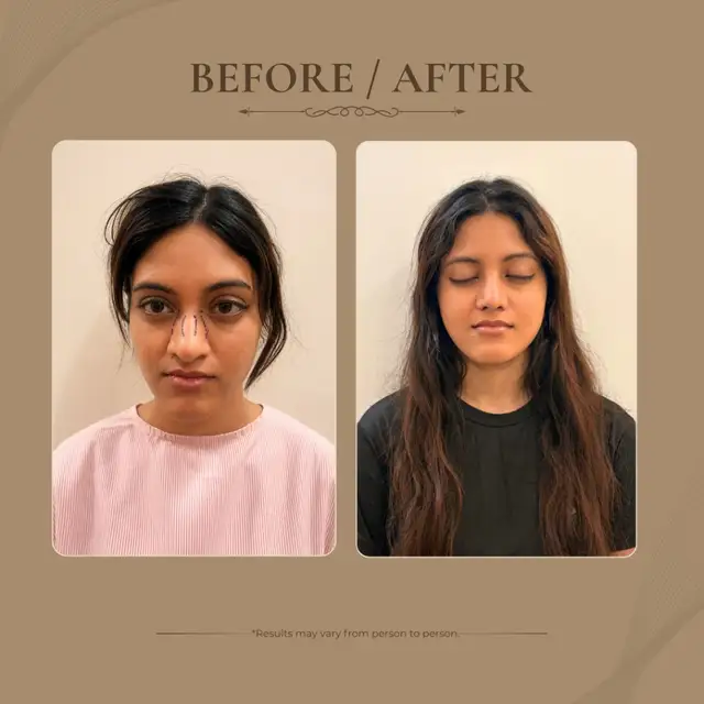Rhinoplasty before and after result 5