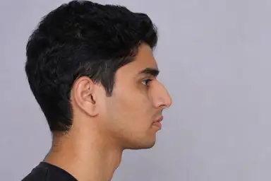 Dorsal hump