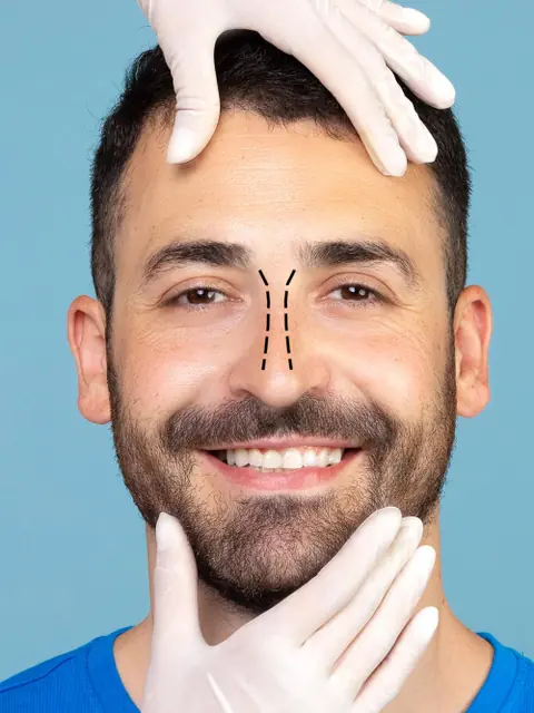 Rhinoplasty assessment at T.R.U.E. Hospitals